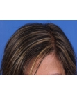 After Hair Transplant &nbsp;Hair Thinning